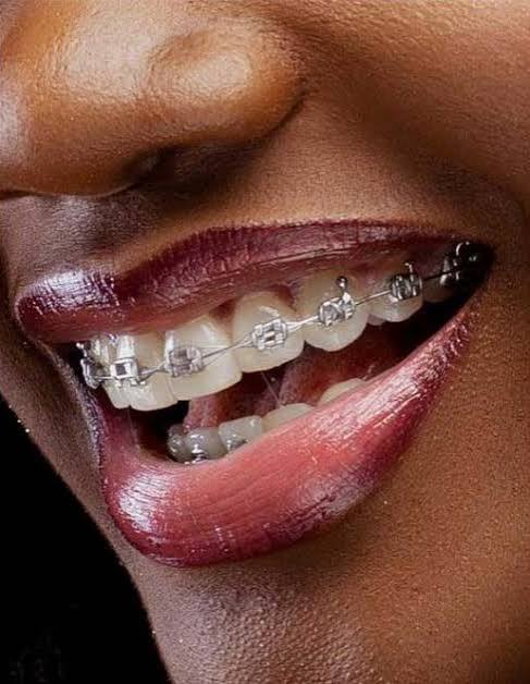 Teeth Straightening