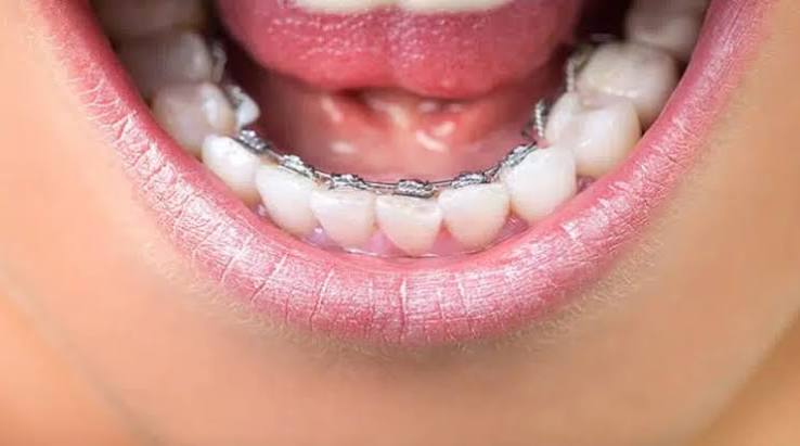 Lingual braces treatment