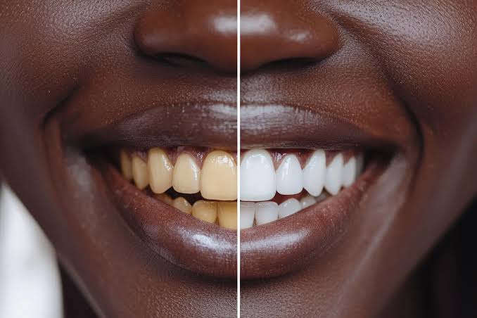 Teeth whitening