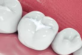 White fillings treatment